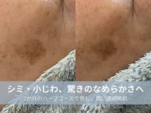 ラシック 加古川店(La chic.)/シミ・しわへ徹底アプローチ
