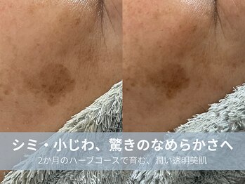 ラシック 加古川店(La chic.)/シミ・しわへ徹底アプローチ