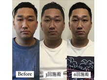 コルミチョン サロン(骨美整 salon)/Before→3回施術→6回施術