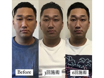 コルミチョン サロン(骨美整 salon)/Before→3回施術→6回施術