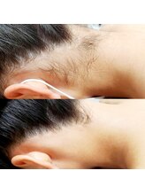 リリィ(Riliy)/うなじワックス脱毛