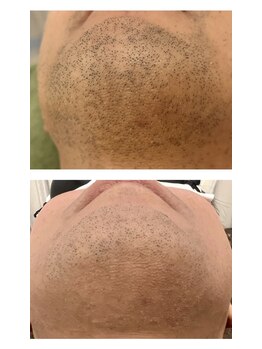 ヴィヴ コレビ(VIV COREBI)/一度の効果♪絶大!