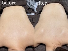 ビビ(Vivi)/お背中ハーブピーリング