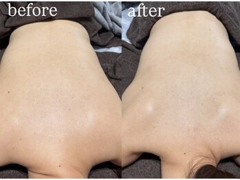 ビビ(Vivi)/お背中ハーブピーリング