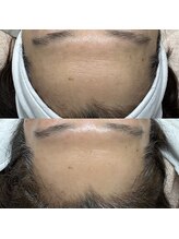 ラニー アンド ココネイル(LANIE&CocoNail)/毛穴スペシャルケア