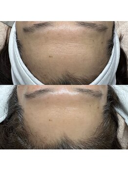 ラニー アンド ココネイル(LANIE&CocoNail)/毛穴スペシャルケア