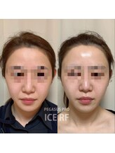 カミングオーツー(髪ingO2)/RFフェイシャル