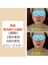 ドクターマジックタッチ(Dr.MAGIC TOUCH)/【劇的小顔術】ビフォーアフター