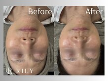 リリー(RILY)/【ポテンツァビフォーアフター】