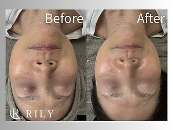 リリー(RILY)/【ポテンツァビフォーアフター】