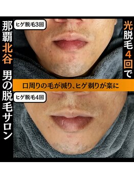 ディースタイル 北谷店(Dstyle)/北谷メンズ脱毛ヒゲBefore after
