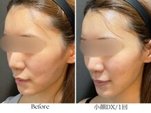 ビボーラ(BEBEAURA)/スリムDX1回