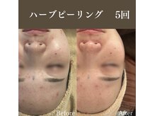 サロンドペシェ(salon de peche)/ハーブピーリング4回の変化