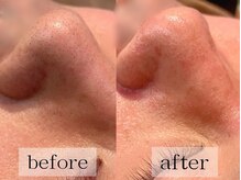 グランビューティ(Glanz Beauty)の雰囲気（最新機器で従来の毛穴洗浄よりも低刺激◎水流の力で汚れをオフ）