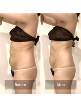 アラマンダ(Allamanda)/腹部吸引BeforeAfter