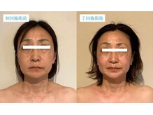 マリーボーテ 名古屋店/【小顔７回】口横のたるみ改善