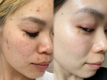 エステティック リベル キョウト 京都駅前店(Esthetic Liber Kyoto)の雰囲気（肌質改善ピーリング）