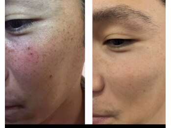 ココリラ(cocorira)の写真/夏までにシミ改善！プラズマケア1箇所無料◎2・3回目半額♪悩みを卒業し透明感肌へ！