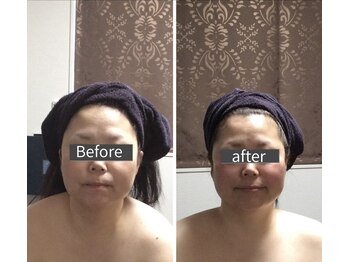 小顔アンドエイジングケア専門店 ビゼ(美sser)/美sser小顔コルギ