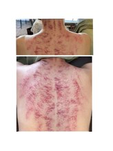 ビーオリビン(B-olivine)/カッサ　首肩/背中 経絡に沿って