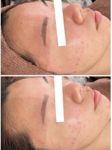 ホワイトアクア 岐阜店(WHITE AQUA)/ハーブピーリング/岐阜/ニキビ