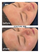 ルピナス ヒサヤ(LUPINUS hisaya)/韓国から上陸！水光ピール