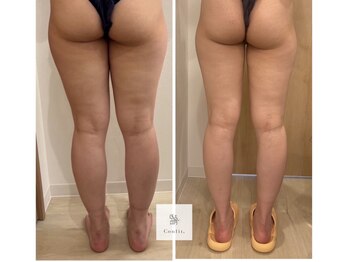 ミセルビューティー 御堂筋本町(micell beauty)/脂肪分解