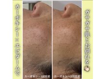 ハニエル(Haniel)/カーボキシー症例