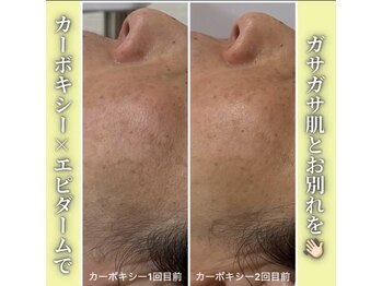 ハニエル(Haniel)/カーボキシー症例