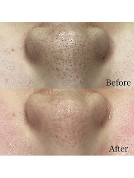 ダリアビューティー(Dahlia Beauty)/ハイドラ＋鼻脱毛Before After