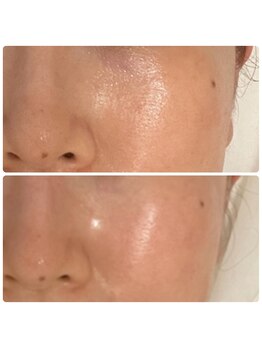 アネランスパ(Anelan Spa.)/ヒト幹細胞で毛穴レス肌