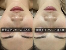 グラン ジュテ/美肌に！臍帯エクソソーム注入