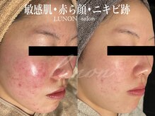 ルノン(Lunon)/肌質改善　《症例》