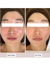 ムー(mu)/ララピール/赤みが消えツヤ肌に