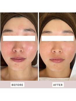 ムー(mu)/ララピール/赤みが消えツヤ肌に