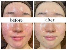 アリエス/肌質改善［毛穴/黒ずみ/ニキビ］