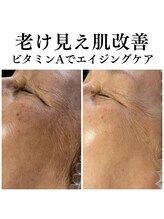 フェリス(FELIZ)/純粋レチノールピール