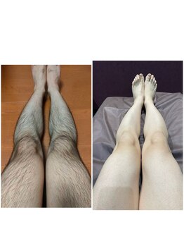 グロー(GLOW)/メンズ足脱毛