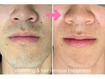 ハピネス 広島並木通り店(Happiness)/ヒゲ脱毛Before→After