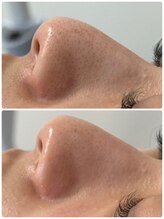 ビンナ(BINNA)/ビフォーアフター【毛穴洗浄】