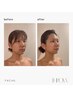 《フェイシャル/facial》インディバ+整顔小顔矯正60分¥18000