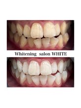 ホワイトニングサロン ホワイト 津山店(WHITE)/ビフォーアフター