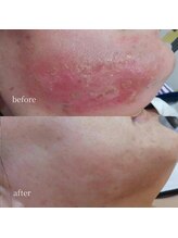 アーネスト 大阪心斎橋店(EARNEST)/韓国式光美容【 剥離肌の修復 】