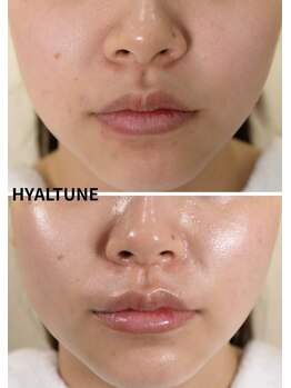 ルピナス ヒサヤ(LUPINUS hisaya)/韓国から上陸！水分ピール