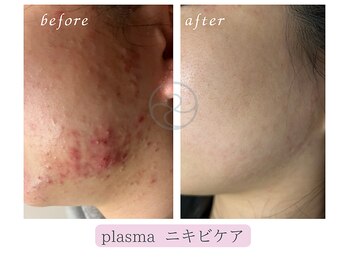 小顔×肌質ケア&経絡ヒーリングKimusubi /プラズマ導入のニキビケア