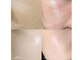 ビューティーサロン リリー(Lily)の写真/憧れの水光肌へ導くプレミアム美白施術。１回の施術で効果実感。