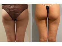 ルナグランデ(Luna grande.)/内太ももに効果◎！