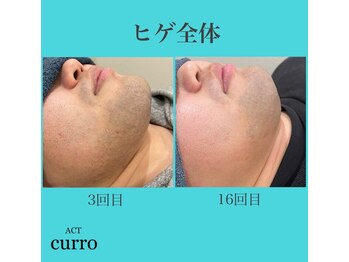 アクト クロ(ACT curro)/【ヒゲ全体】脱毛施術例
