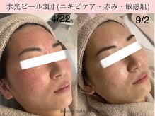 ラエッセ(La Esse)/高濃度AHAピールで肌荒れケア