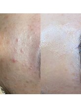 ミーミー 多治見店(MeMe.)/毛穴エクストラクション